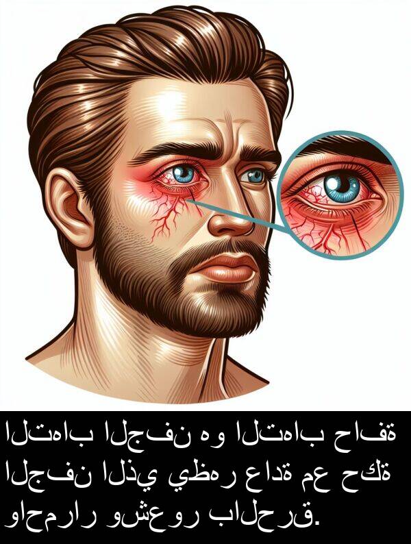 عادة: التهاب الجفن هو التهاب حافة الجفن الذي يظهر عادة مع حكة واحمرار وشعور بالحرق.