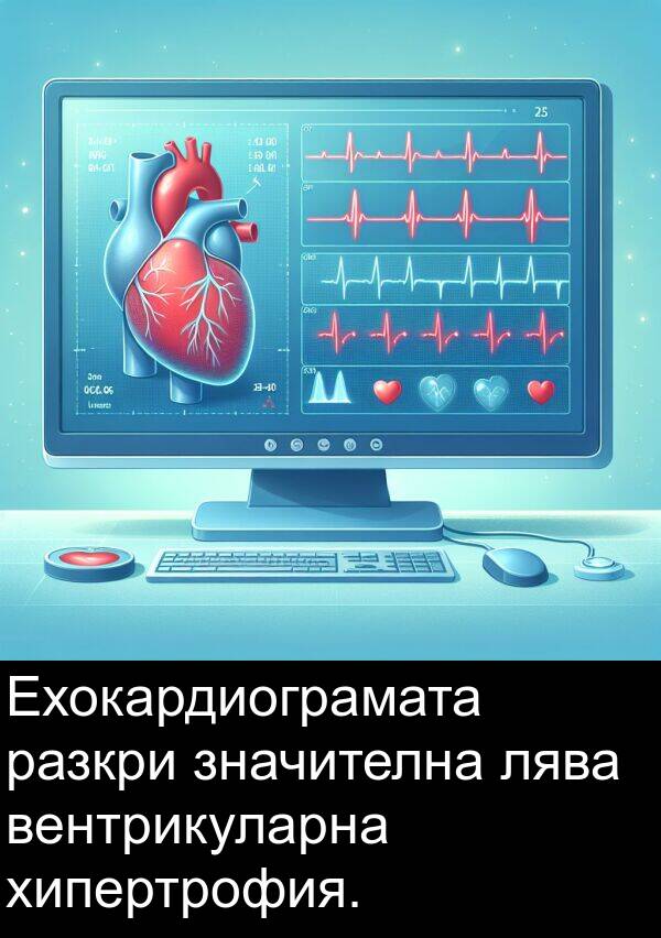 разкри: Ехокардиограмата разкри значителна лява вентрикуларна хипертрофия.