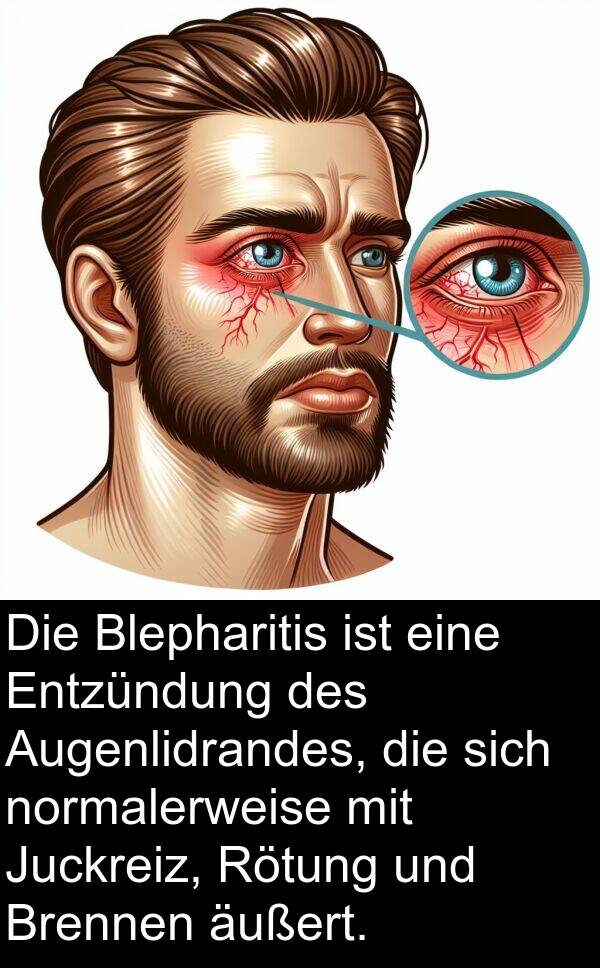 Entzündung: Die Blepharitis ist eine Entzündung des Augenlidrandes, die sich normalerweise mit Juckreiz, Rötung und Brennen äußert.