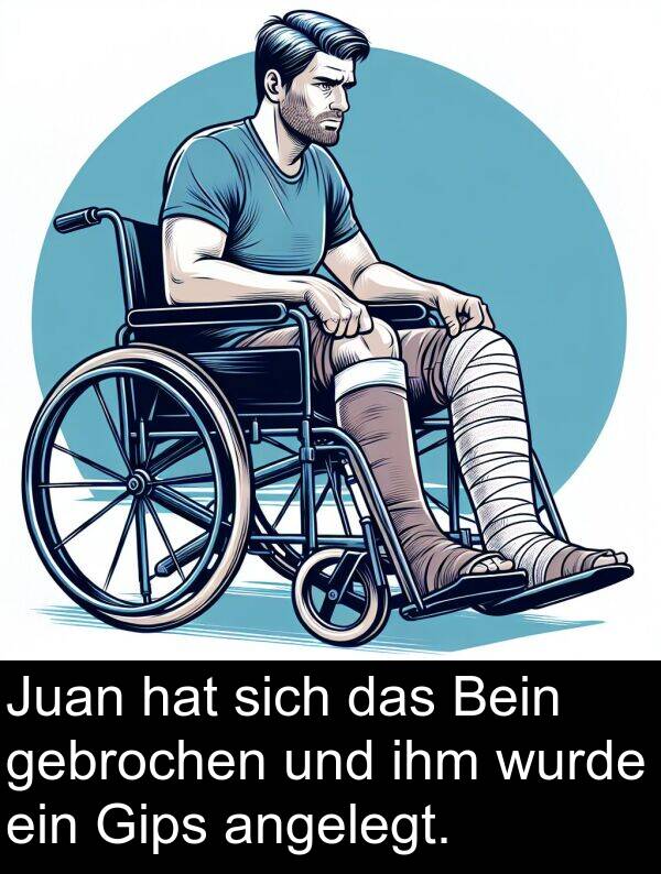 gebrochen: Juan hat sich das Bein gebrochen und ihm wurde ein Gips angelegt.