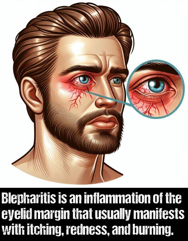 margin: Blepharitis is an inflammation of the eyelid margin that usually manifests with itching, redness, and burning.