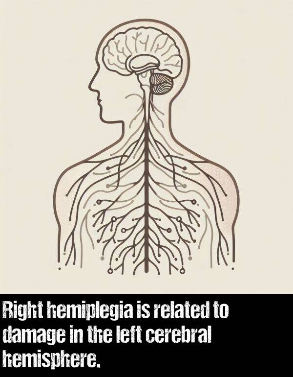 left: Right hemiplegia is related to damage in the left cerebral hemisphere.