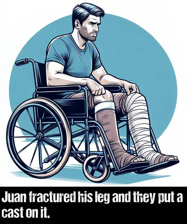 they: Juan fractured his leg and they put a cast on it.