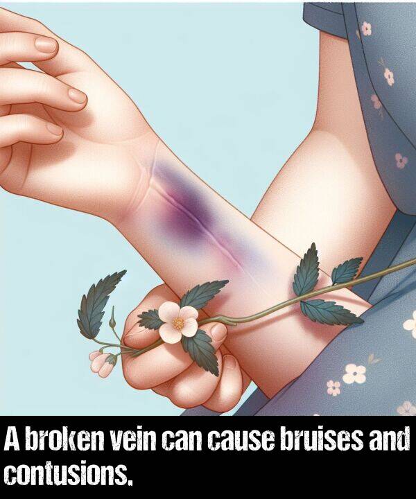 cause: A broken vein can cause bruises and contusions.