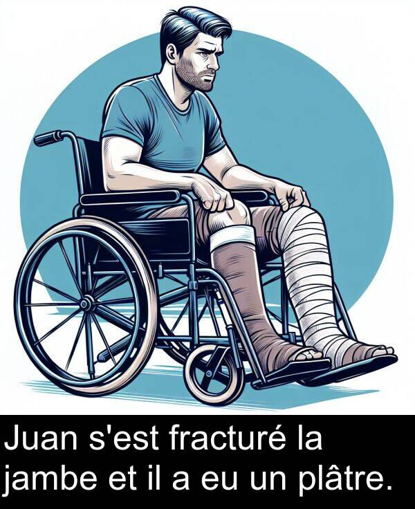 plâtre: Juan s'est fracturé la jambe et il a eu un plâtre.