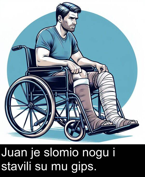 gips: Juan je slomio nogu i stavili su mu gips.