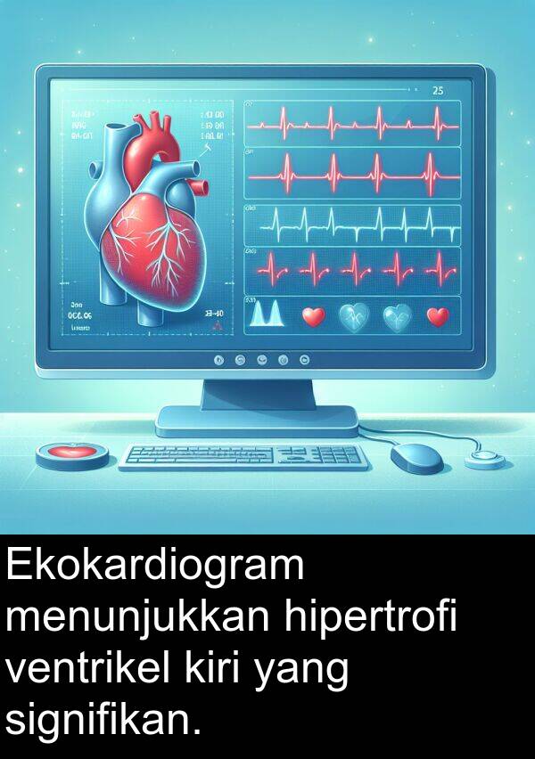 hipertrofi: Ekokardiogram menunjukkan hipertrofi ventrikel kiri yang signifikan.