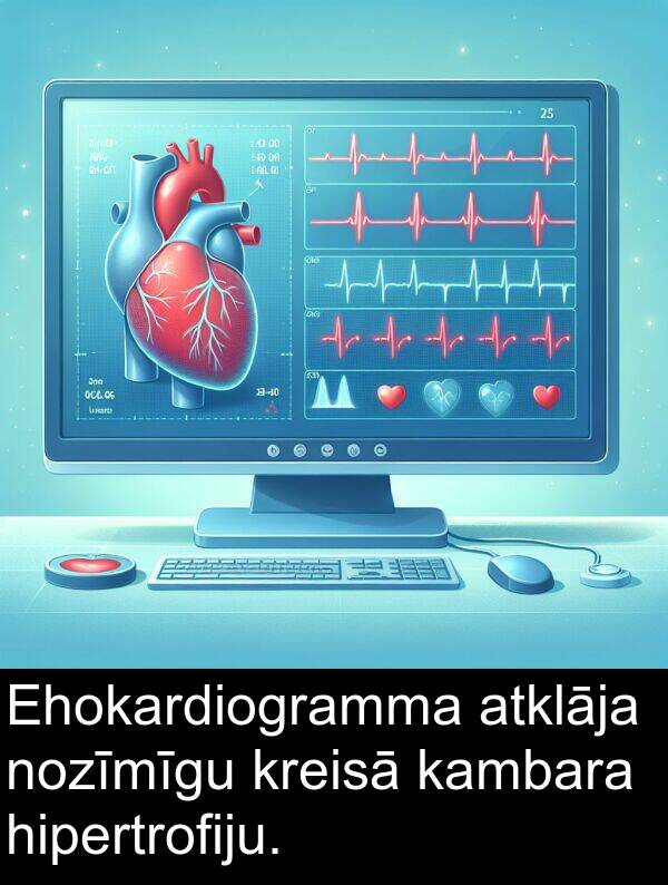 nozīmīgu: Ehokardiogramma atklāja nozīmīgu kreisā kambara hipertrofiju.