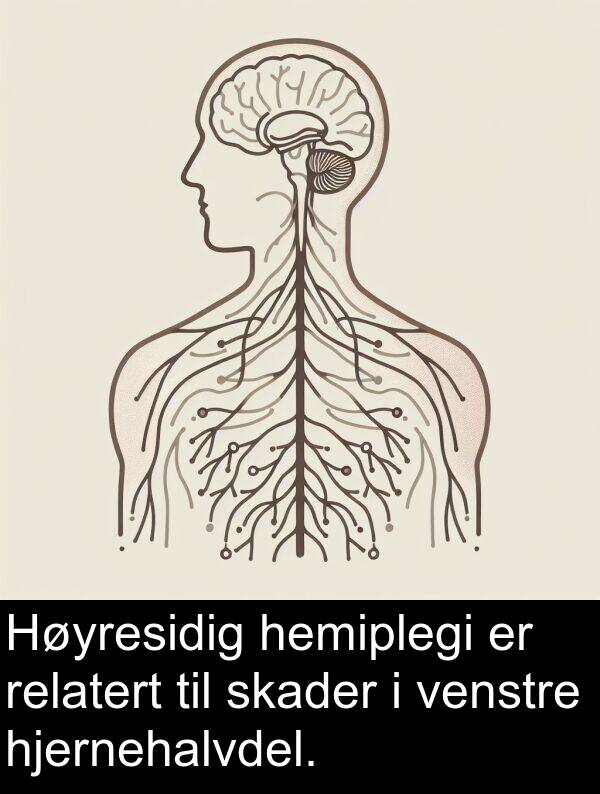 hemiplegi: Høyresidig hemiplegi er relatert til skader i venstre hjernehalvdel.