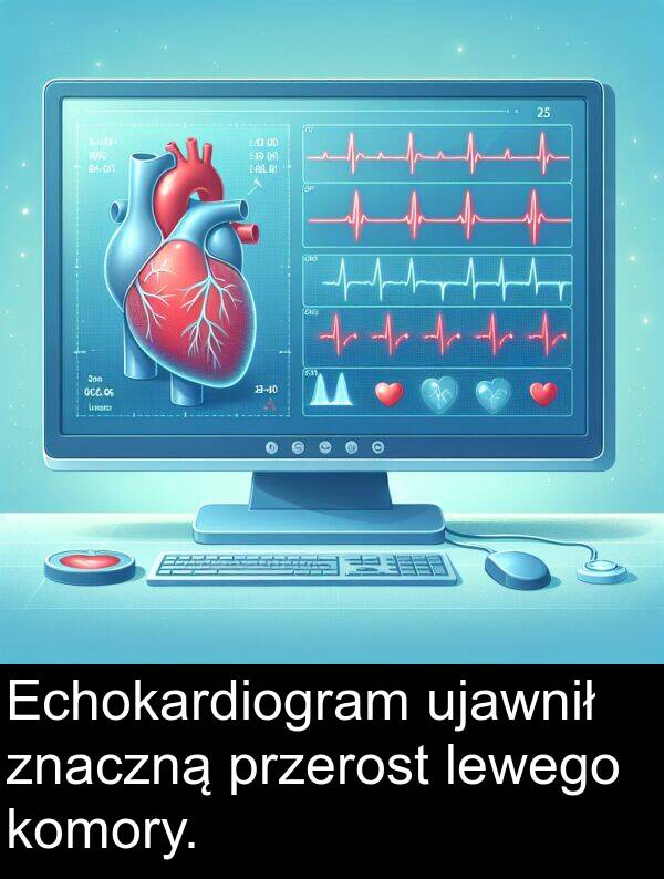 ujawnił: Echokardiogram ujawnił znaczną przerost lewego komory.