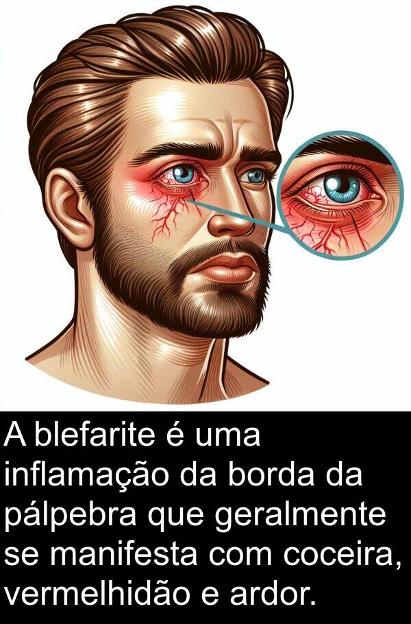 geralmente: A blefarite é uma inflamação da borda da pálpebra que geralmente se manifesta com coceira, vermelhidão e ardor.