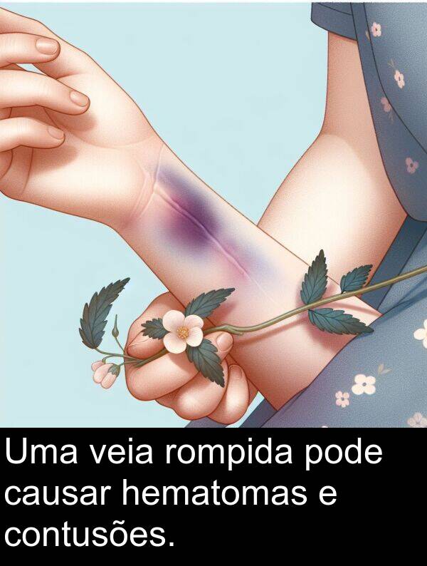 veia: Uma veia rompida pode causar hematomas e contusões.