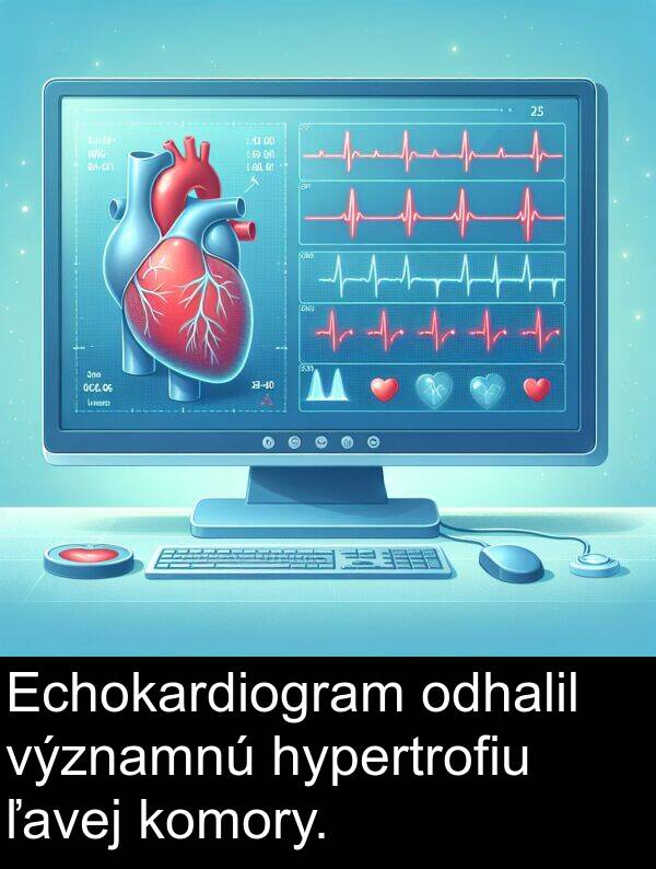 ľavej: Echokardiogram odhalil významnú hypertrofiu ľavej komory.