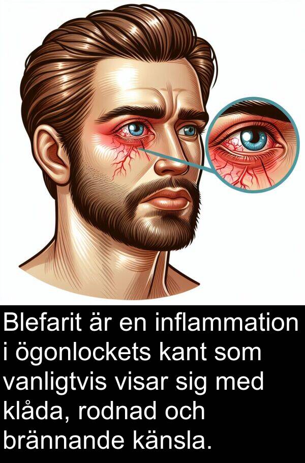 kant: Blefarit är en inflammation i ögonlockets kant som vanligtvis visar sig med klåda, rodnad och brännande känsla.