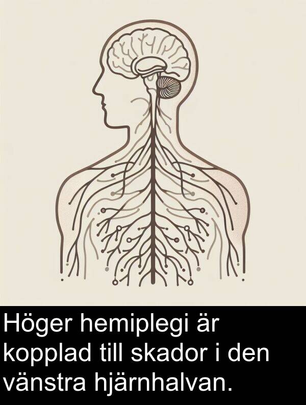 hemiplegi: Höger hemiplegi är kopplad till skador i den vänstra hjärnhalvan.