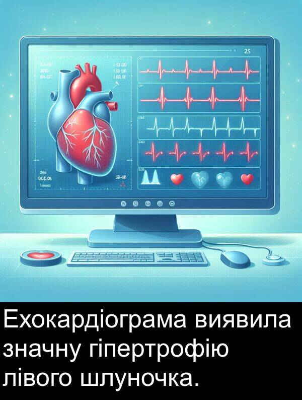 лівого: Ехокардіограма виявила значну гіпертрофію лівого шлуночка.