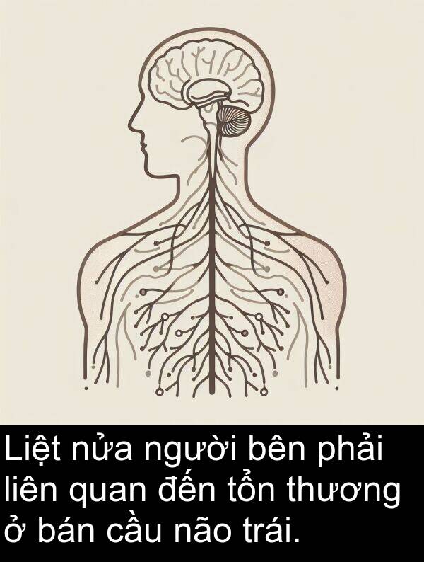 liên: Liệt nửa người bên phải liên quan đến tổn thương ở bán cầu não trái.